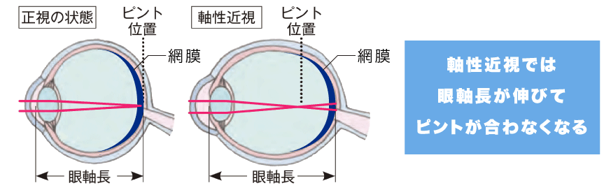 軸性近視では眼軸長が伸びてピントが合わなくなる