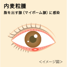 麦粒腫 ばくりゅうしゅ ものもらい はなぜできる くせになるの 瞳のギモン アキュビュー 公式