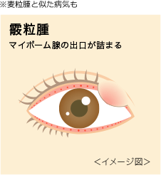 麦粒腫 ばくりゅうしゅ ものもらい はなぜできる くせになるの 瞳のギモン アキュビュー 公式